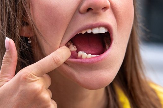 Patient in South End showing missing tooth