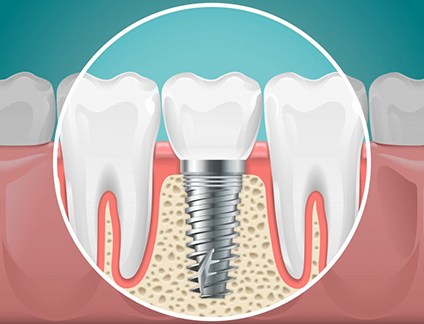 Digital image of a dental implant fused with a jawbone
