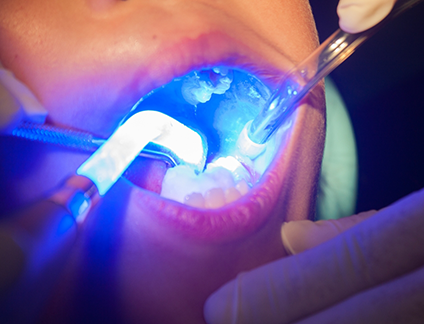 Close up of a child receiving dental sealants on their teeth