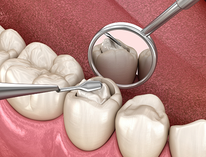 Illustration of a filling being placed inside of a tooth