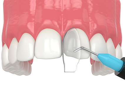 Illustration of bonding material being placed over a chipped tooth