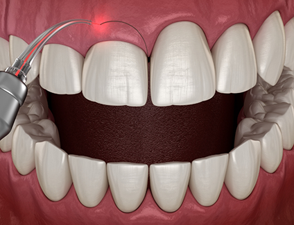 Illustration of a dental laser treating an uneven gumline