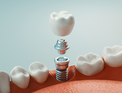 Illustrated dental implant with crown being placed into the lower jaw