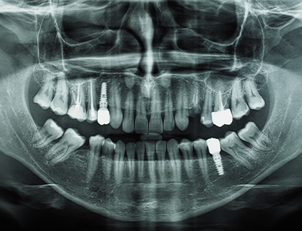 X ray of an entire set of teeth