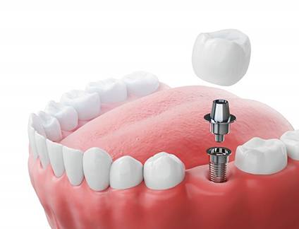 a 3D illustration of a dental implant