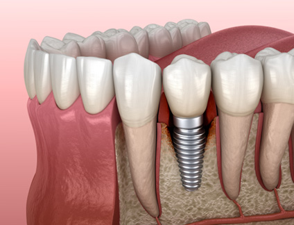 Illustration of bone loss around a failed dental implant in Peabody