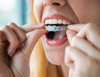 Person placing an Invisalign aligner over their upper teeth