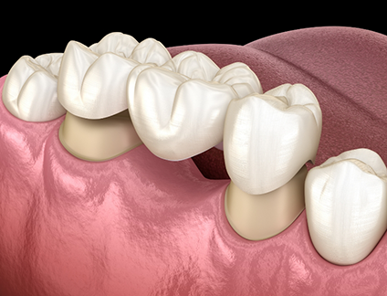 Illustrated dental bridge filling the gap between two teeth