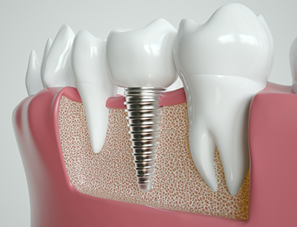 Illustrated dental implant in the jawbone replacing a missing lower tooth