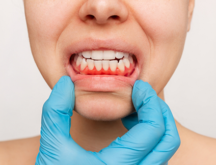 Person pulling down their lower lip to expose red gums