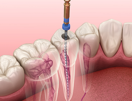 Illustrated dental instrument treating the inside of a tooth